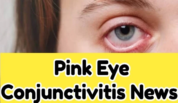 Pink Eye Conjunctivitis News